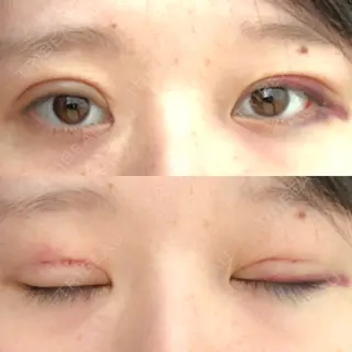 2日目の経過画像（1枚目）
