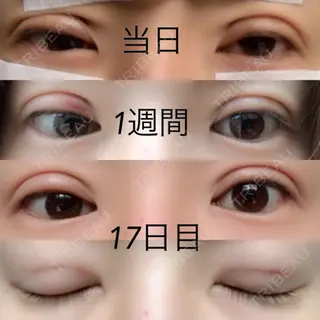 17日目の経過画像（1枚目）