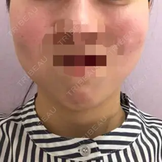 0日目の経過画像（2枚目）