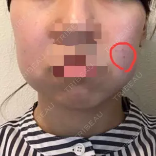 0日目の経過画像（1枚目）