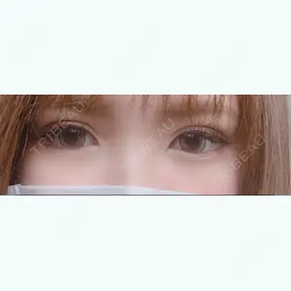 7日目の経過画像（1枚目）