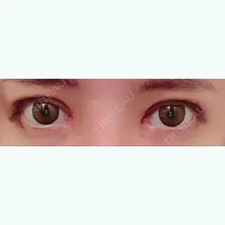 6日目の経過画像（1枚目）