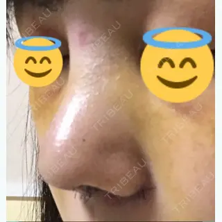 6日目の経過画像（2枚目）