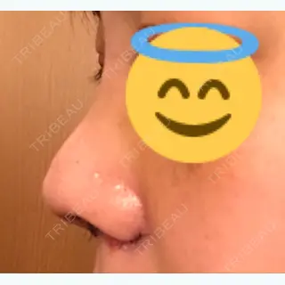 7日目の経過画像（2枚目）