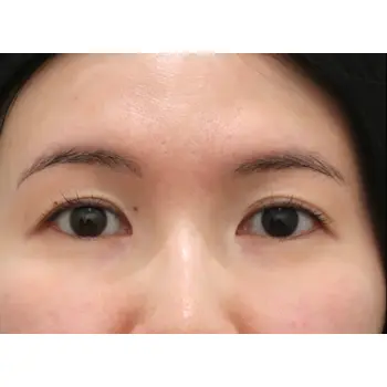 before image