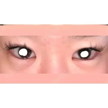 before image