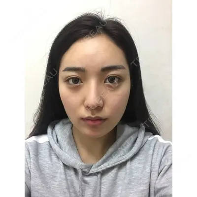 TL美容整形外科 顔面輪郭・目・鼻センター チェ・セウン医師の症例