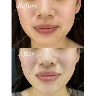 HAAB×DREAM BEAUTY CLINIC 東京本院の症例