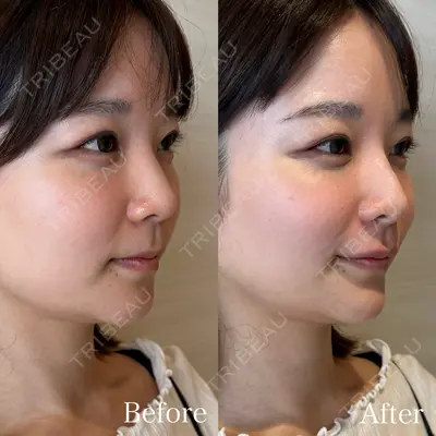 HAAB×DREAM BEAUTY CLINIC 東京本院 吉岡 修一医師の症例