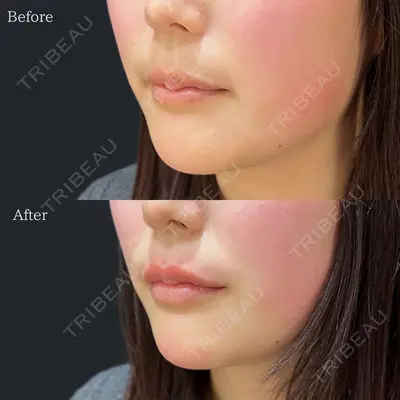 HAAB×DREAM BEAUTY CLINIC 東京本院 佐野 圭医師の症例
