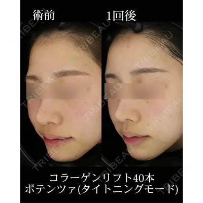 HAAB×DREAM BEAUTY CLINIC 東京本院の症例