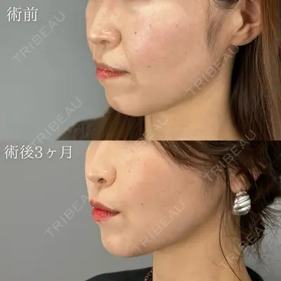 TCB東京中央美容外科 越谷院の症例