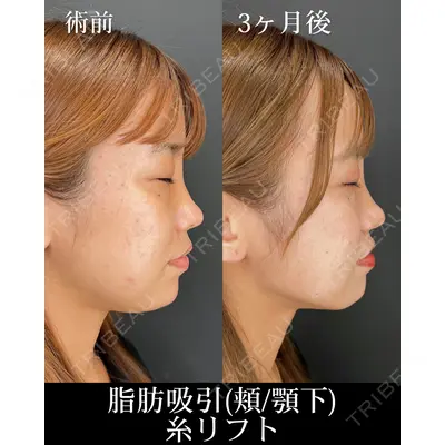 HAAB×DREAM BEAUTY CLINIC 大阪梅田院 柏木 太雅医師の症例