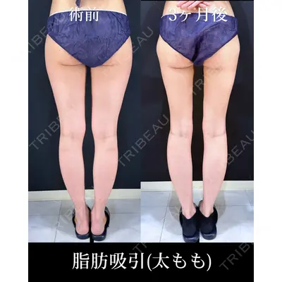 HAAB×DREAM BEAUTY CLINIC 東京本院 吉岡 修一医師の症例