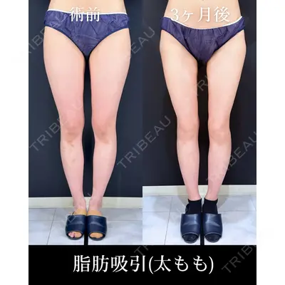 HAAB×DREAM BEAUTY CLINIC 東京本院 吉岡 修一医師の症例