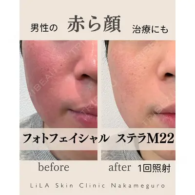 LiLAスキンクリニック中目黒 森田 裕子医師の症例