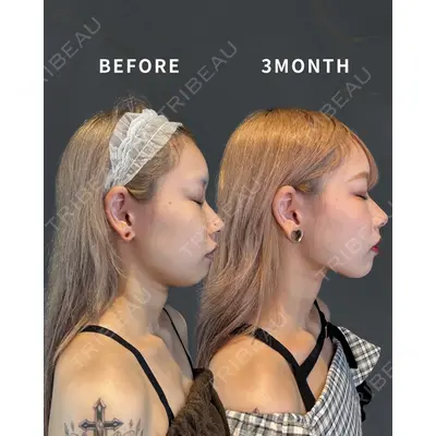 HAAB×DREAM BEAUTY CLINIC 大阪梅田院の症例