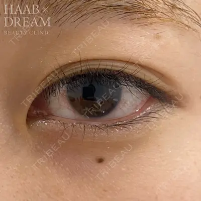 HAAB×DREAM BEAUTY CLINIC 東京本院 田中 優太医師の症例