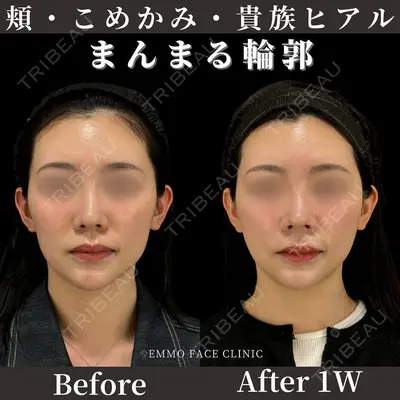 EMMO FACE CLINIC 東京三田院 木之下 哲彦医師の症例