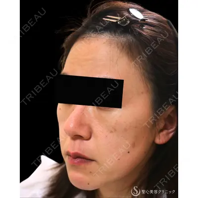 聖心美容クリニック 熱海院 小林 美幸（皮膚科）医師の症例
