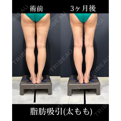 HAAB×DREAM BEAUTY CLINIC 東京本院 吉岡 修一医師の症例