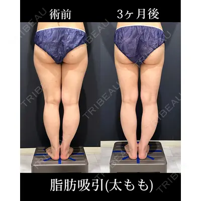 HAAB×DREAM BEAUTY CLINIC 東京本院 吉岡 修一医師の症例