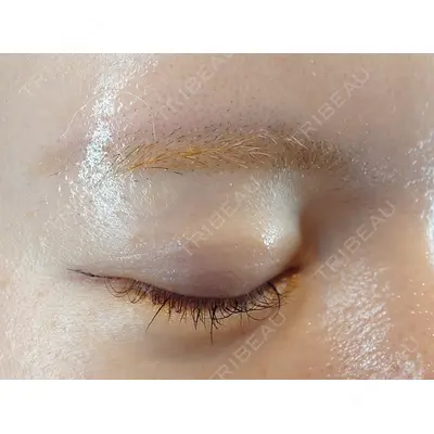 HAAB BEAUTY CLINIC 南青山本院（新院） 小平 佳典医師の症例