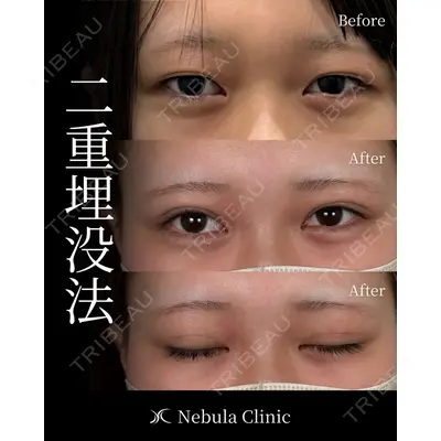 愛知春日井美容外科ネビュラクリニック 都築 諒医師の症例
