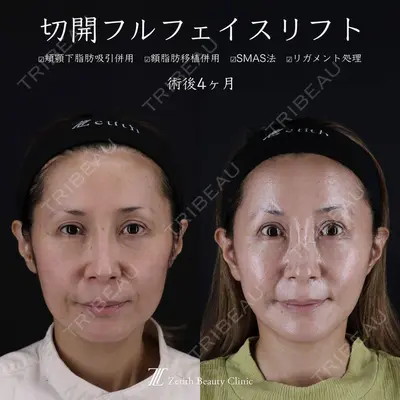 Zetith Beauty Clinic 新宿院 王 蘇医師の症例