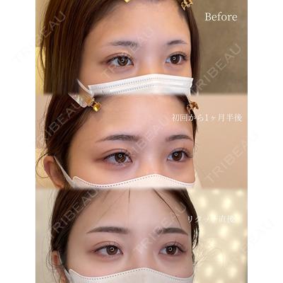 REVO CLINIC PLUSの症例
