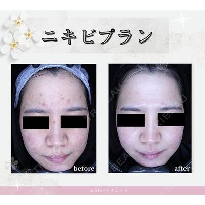SUBCLi（＆ABCクリニック）の症例