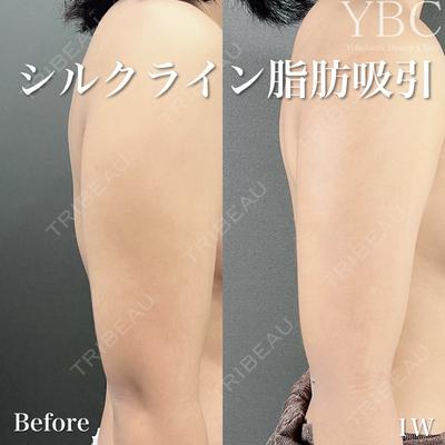 YBC横浜美容外科 立川院 塚原健汰医師の症例