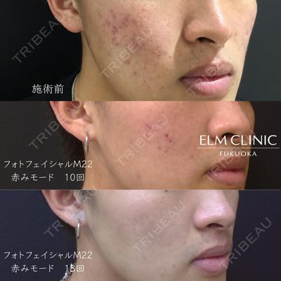 美容皮膚科エルムクリニック 福岡院 白水 翼医師の症例
