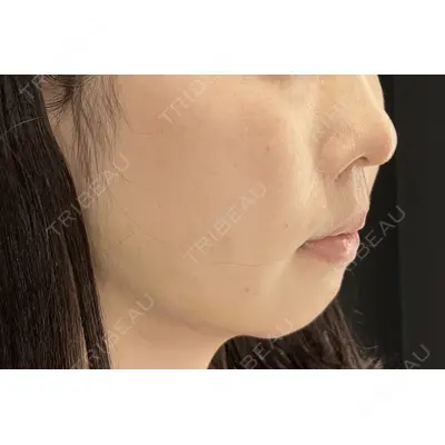 HAAB×DREAM BEAUTY CLINIC 大阪梅田院 鈴木 馨斗医師の症例