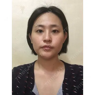 TL美容整形外科 顔面輪郭・目・鼻センター チェ・セウン医師の症例