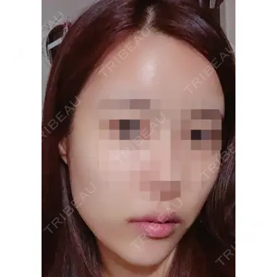TL美容整形外科 顔面輪郭・目・鼻センター チェ・セウン医師の症例