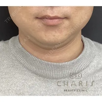 CHARIS BEAUTY CLINICの症例