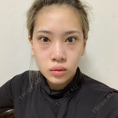 TL美容整形外科 顔面輪郭・目・鼻センター チェ・セウン医師の症例