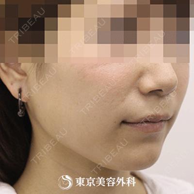 東京美容外科 梅田院 木村 幸志伊医師の症例