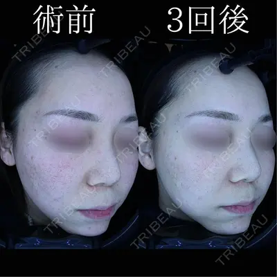 HAAB×DREAM BEAUTY CLINIC 東京本院の症例