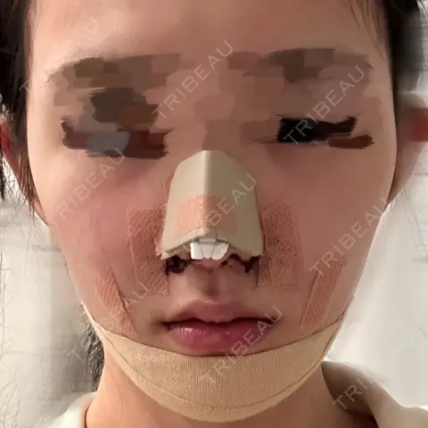 鼻尖形成（切開） / 小鼻縮小（切開） / 軟骨移植 / 鼻尖縮小 / 鼻翼基部形成（貴族手術） 銀座マイアミ美容外科 DAY 0