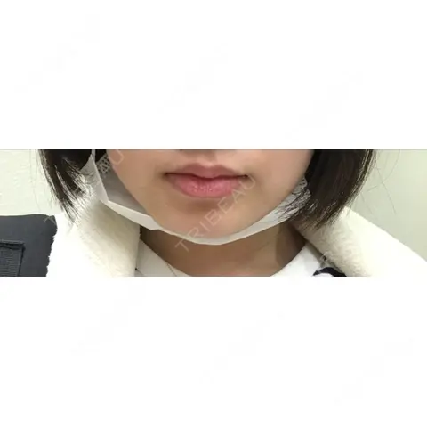 脂肪溶解注射（まぶた） 横浜中央クリニック 横浜院 DAY 0