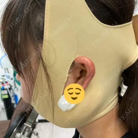 糸リフト / 脂肪吸引（顔） BLINC CLINIC （ブリンク クリニック） DAY 0