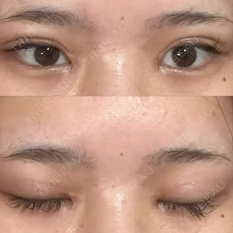 二重埋没 / 目頭切開 HAAB×DREAM BEAUTY CLINIC 大阪梅田院 AFTER