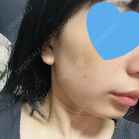 光治療（フォトフェイシャルなど） まゆりなclinic 名古屋栄 DAY 0
