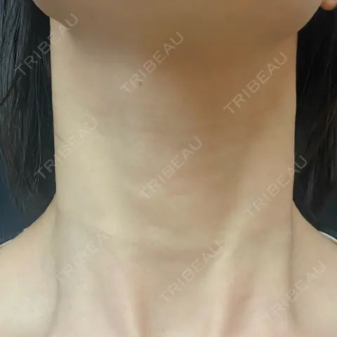 ヒアルロン酸注入（首） 湘南美容クリニック 京都院 AFTER