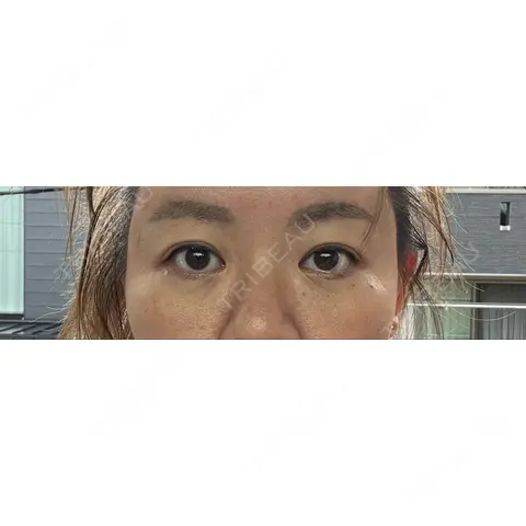 下まぶたたるみ取り / 脂肪注入（目の下） X CLINIC 銀座院 AFTER
