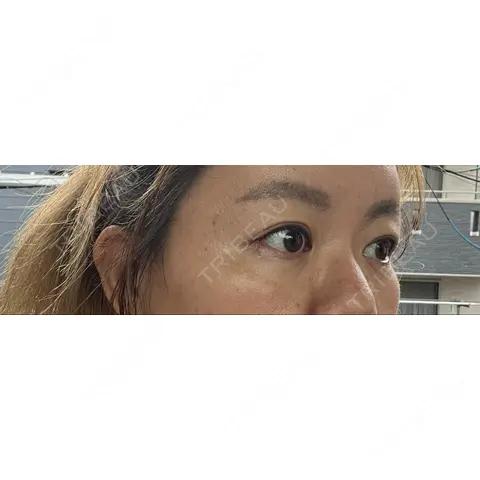 下まぶたたるみ取り / 脂肪注入（目の下） X CLINIC 銀座院 AFTER