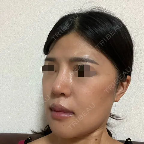 軟骨移植 / ワシ鼻修正・ハンプ切除 / プロテーゼ除去 / 鼻修正 ヒューマン美容外科 AFTER