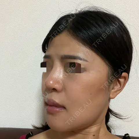 軟骨移植 / ワシ鼻修正・ハンプ切除 / プロテーゼ除去 / 鼻修正 ヒューマン美容外科 AFTER